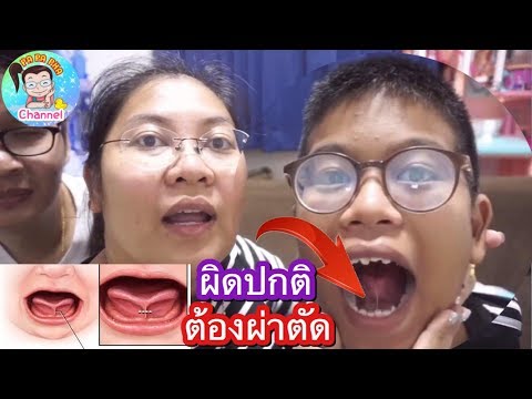 น้องเกรซพูดไม่ชัด จำเป็นต้องผ่าตัดไหม ? l By ครอบครัวแว่น