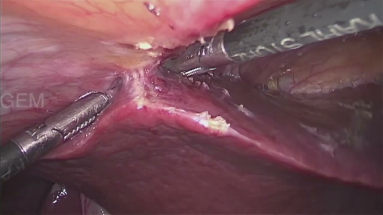 LAPAROSCOPIC ICG GUIDED SEGMENTAL LIVER RESECTION
