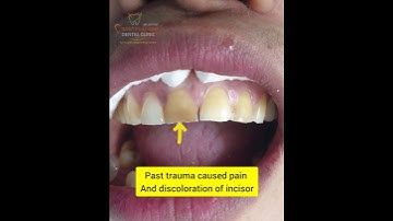 Walking or Internal bleach #dentist #amazing #beautiful #transformation #smile #shorts #viral #teeth