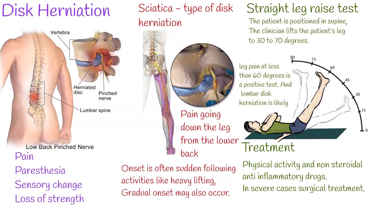 The 5 Types of Back Pain  Your Guide to Identifying Your Back Condition