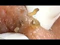 Blackheads Whiteheads Satisfying Removal 0010 Blackheads Whiteheads Satisfying Removal 0010