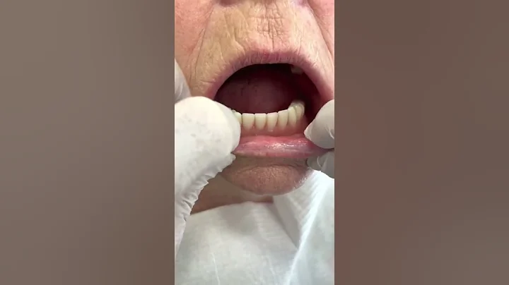Unstable Complete lower Dentues