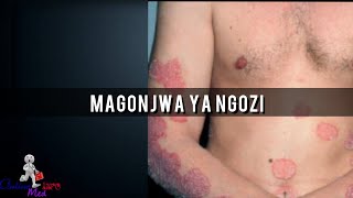 MAGONJWA/MATATIZO YA NGOZI‍‍‍‍‍.