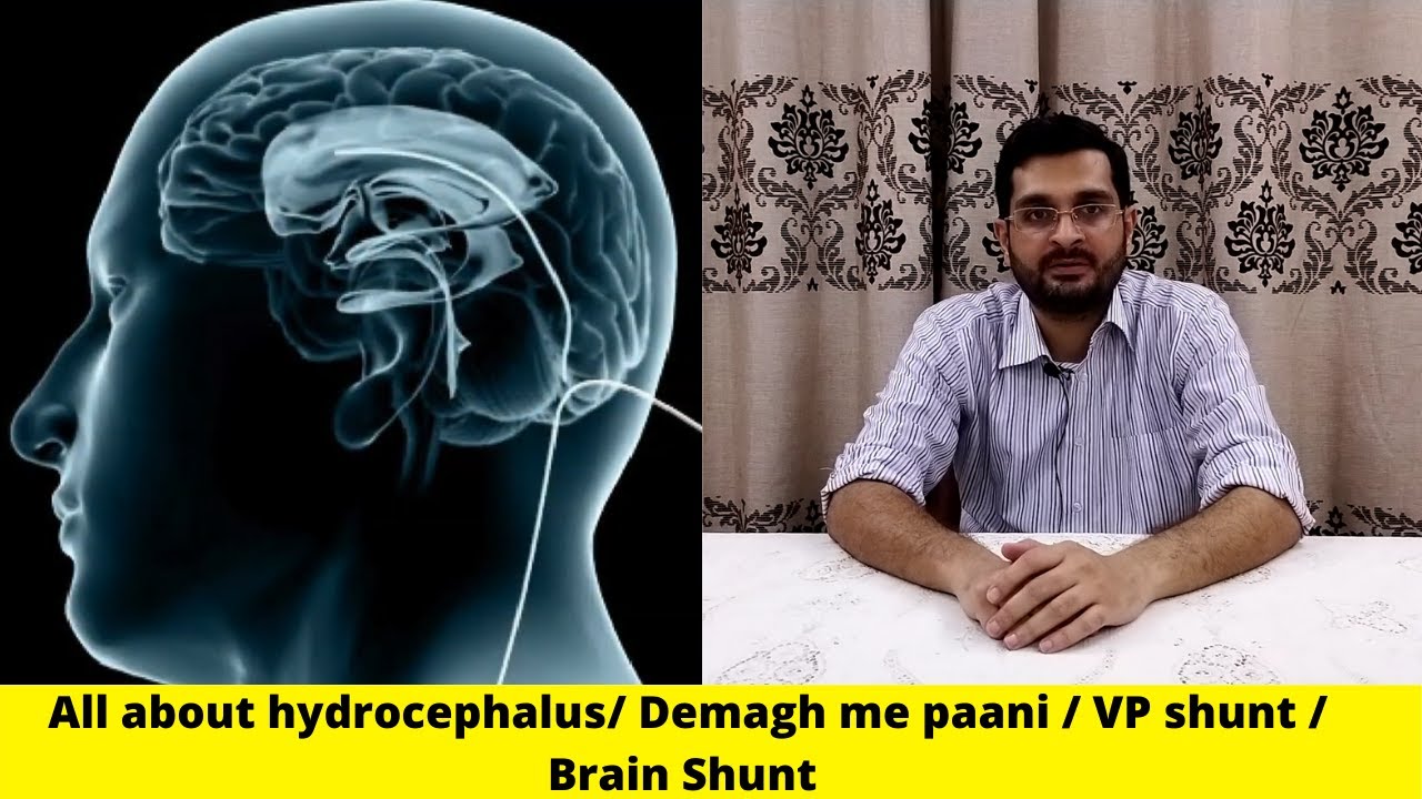 VP Shunt ,brain shunt ,brain surgery, hydrocephalus, water in the brain ,/Dr Yousuf Shaikh YouTube