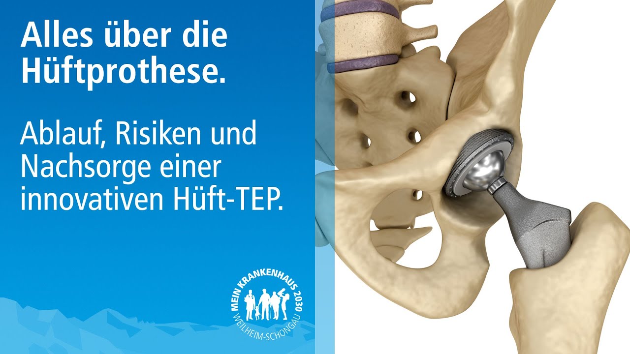 Huft Tep Op Komplikationen Bei Einer Huftprothese Messbar Reduzieren Mako Roboter Assistenz Youtube