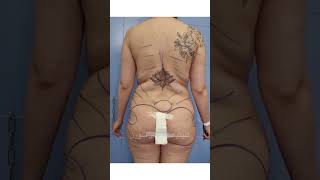 result before and after HD liposculpture and brazilian butt lift BBL , big buttock  لیپوساکشن