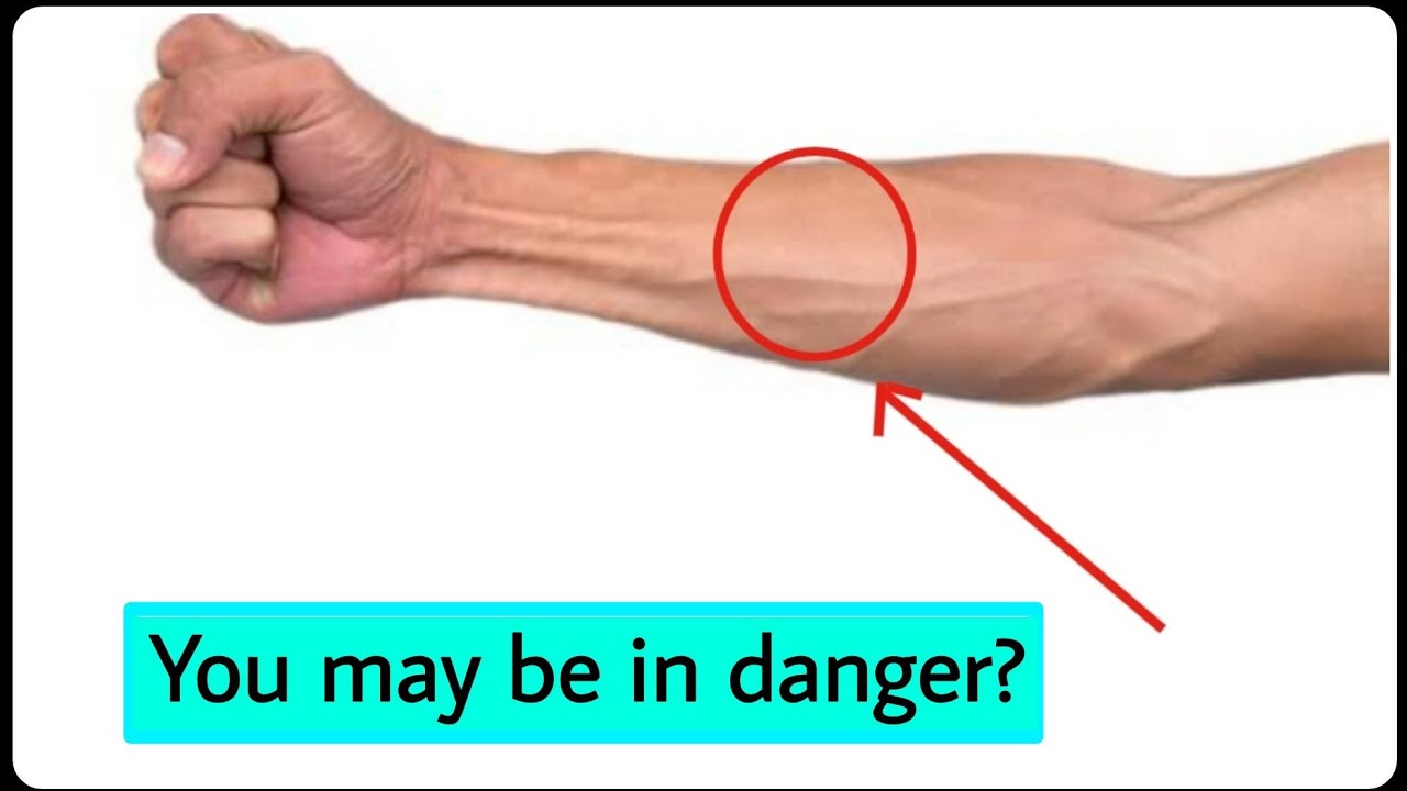 why veins bulge| swelling veins | know the fact - YouTube