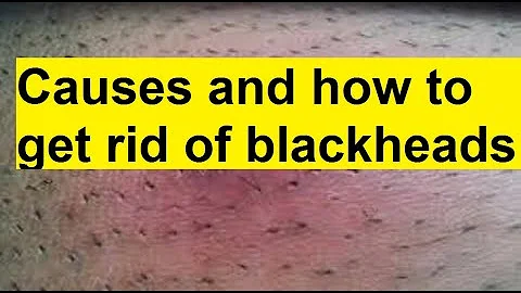 causes and how to remove blackheads