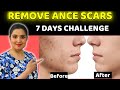 Get Rid of ACNE Scars Naturally /REMOVE PIMPLE MARKS IN 7 DAYS / Acne Marks / Dark Spots #beautytips