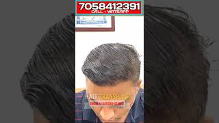 Authentic review After Hair Transplant Result #shortvideo #trending #viral #trendingshorts