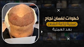 إليك بعض خطوات لضمان نجاح عملية زراعة الشعر بعد العملية د. شريف حجازي