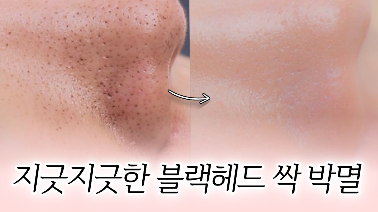 피지연화제 사용방법 총정리  !! 모공 속 피지 박멸!