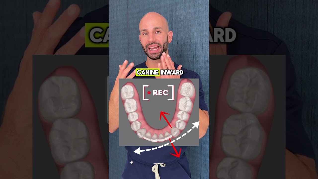 Lower Teeth Overcrowding on an Adult: Fixing with Invisalign