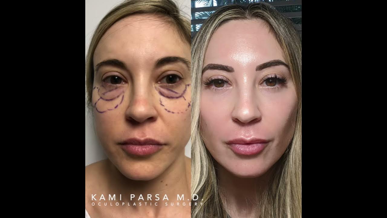 trifecta-lift-get-rid-of-dark-circles-bags-puffy-lower-eyelids-dr