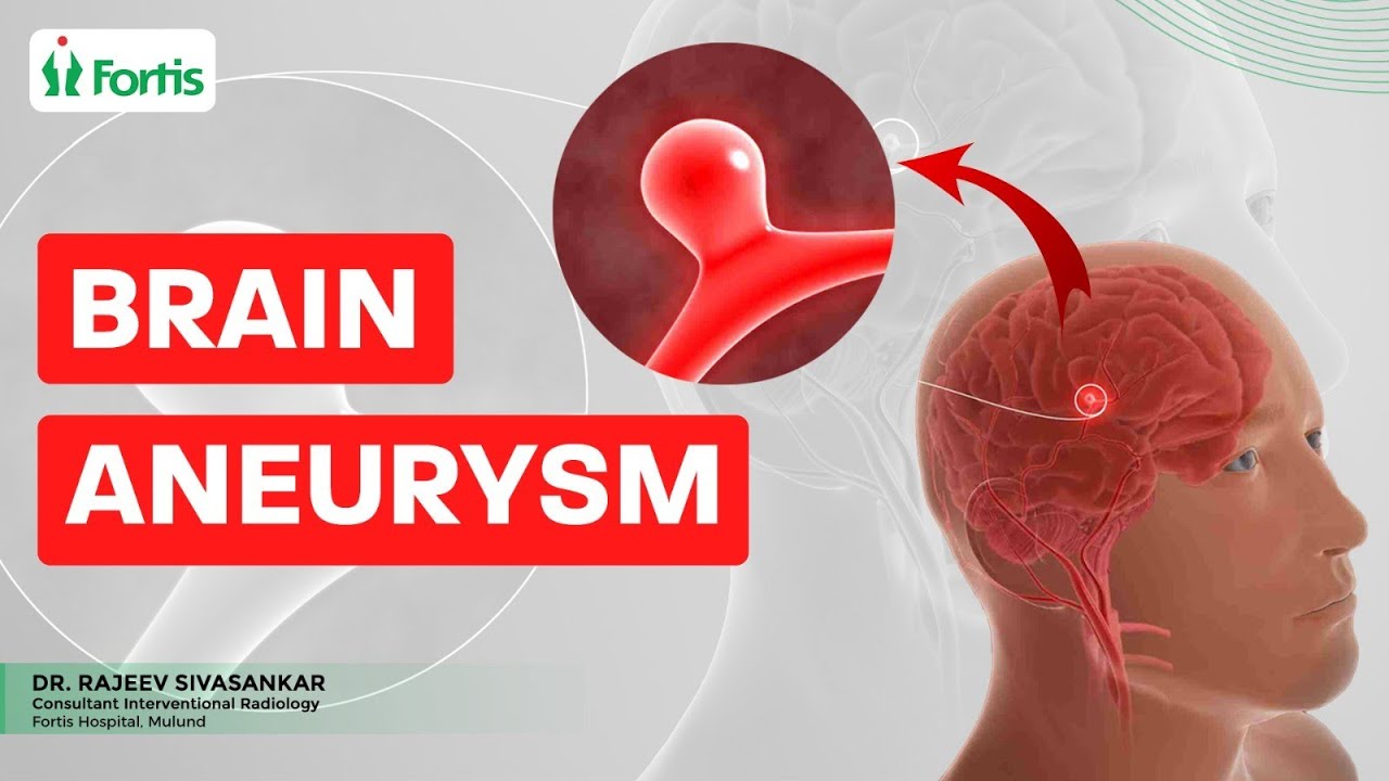 What is a Brain Aneurysm? Causes, Symptoms And Treatment Options | MUL ...