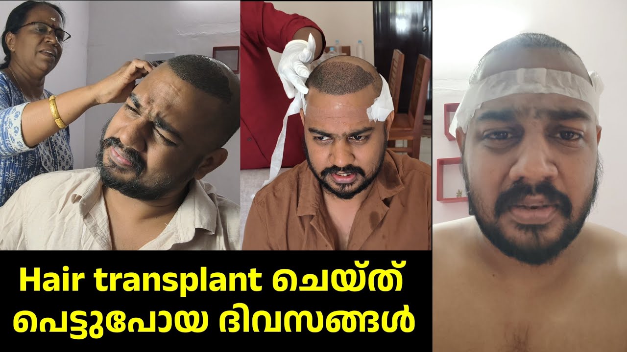 EP02 - Hair transplant ന് ശേഷം ഞാൻ അനുഭവിച്ച ദുരിതങ്ങൾ