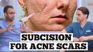 Subcision Acne Scars | Minor Surgery For Acne Scarring | Dr. Somji & Dr. Solomon Explain Acne Scars