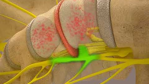 KDT Lumbar Decompression Video in Supine Position