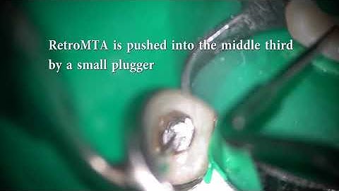 Management of a severe curvature followed by MTA obturation using the T-mode of Ai motor