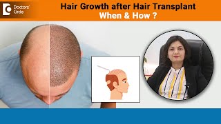 Hair Growth after Hair Transplant Procedure & How fast hair grows - Dr.Aditi Garg | Doctors’ Circle