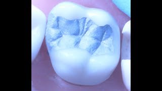 Class II Amalgam Restoration 1 | Operative Dentistry screenshot 5