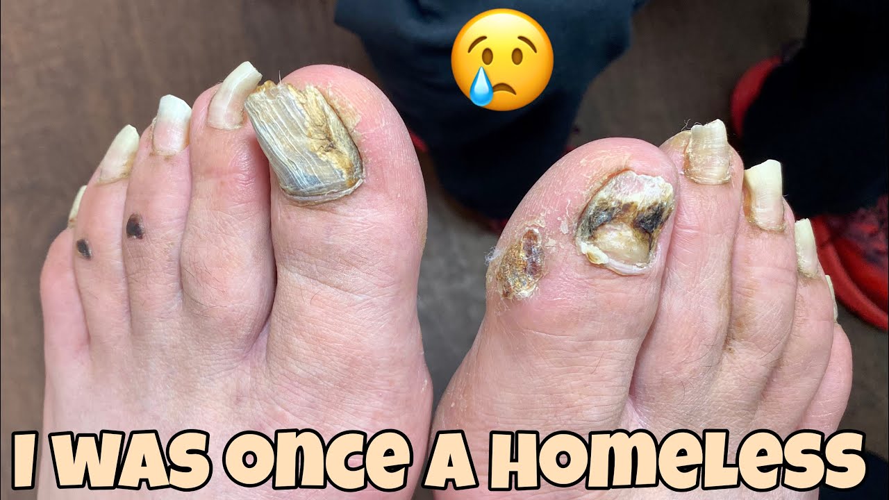 Longest Toenails