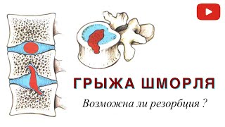 ЛЕЧИТСЯ ЛИ ГРЫЖА ШМОРЛЯ ?