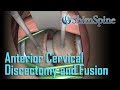 Anterior Cervical Discectomy and Fusion