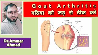 Gout। Arthritis। गठिया की होम्योपैथिक दवा। Best Homeopathic medicine for Uric Acid।gout arthritis