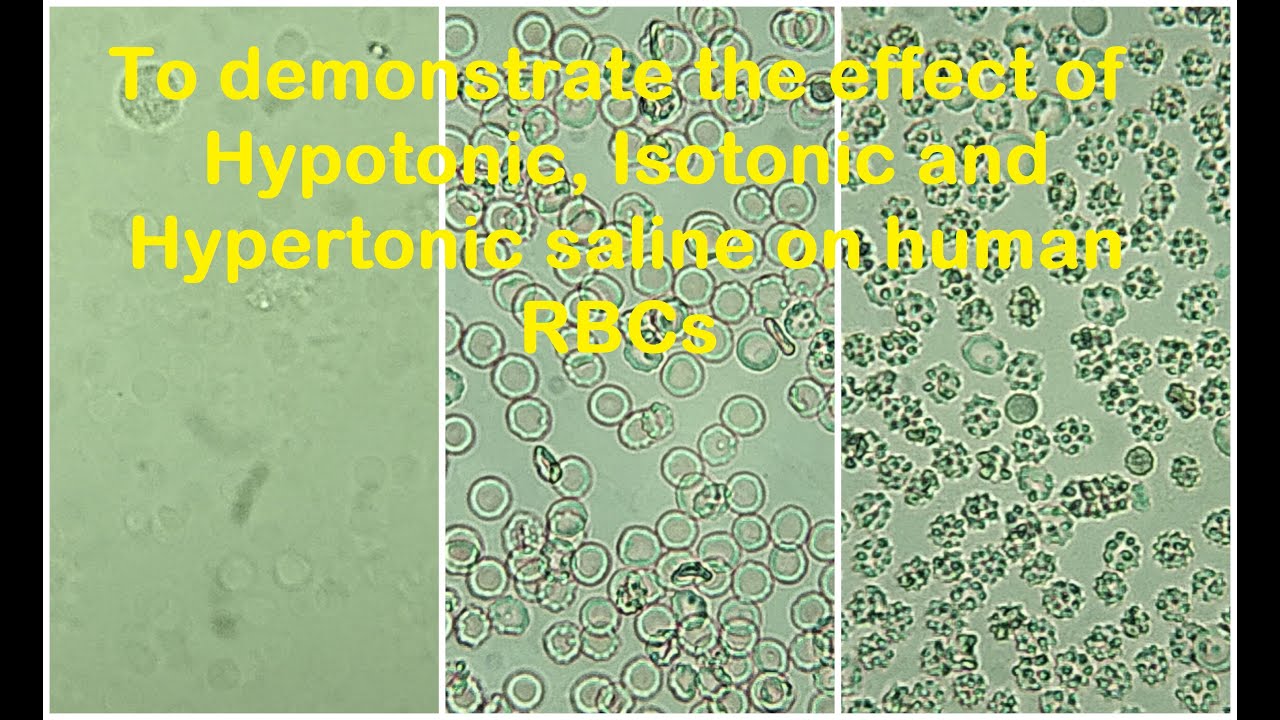 rbc ต่ำ Update RBCs in Hypotonic, Isotonic and Hypertonic solution Practical Lab