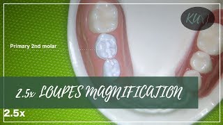 How 2.5x LOUPES became standard in dentistry