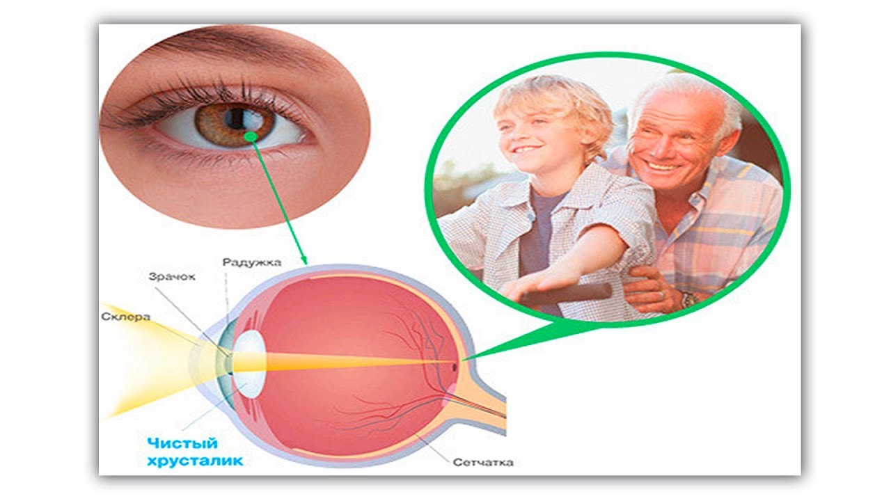 Исправляется ли близорукость с возрастом - YouTube