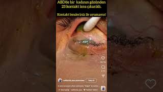 Gözünde 23 Kontak Lens Olan Bir Kadının Bu Videosu Viral Oldu.