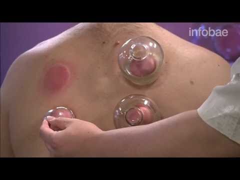 Cupping: cómo es el tratamiento de Michael Phelps