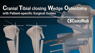 Cranial Tibial closing Wedge Osteotomy(CTWO) with patientspecific surgical guides