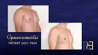 Large Gynaecomastia Excision Of Gland & Vaser Liposuction Bb Grade 3A Patient 2021-7004 B&A