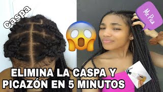 ELIMINA LA CASPA Y PICAZÓN EN 5 MINUTOS | TRENZAS SIN PICAZÓN| REMEDIO CASERO| Rachell Santos