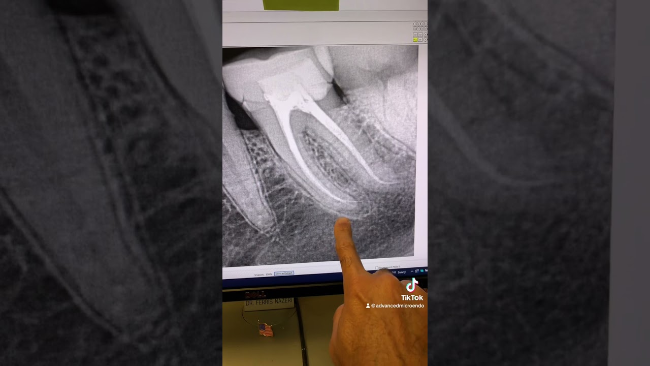 How I redo a root canal. Root canal retx of tooth #19 through a crown in one visit.