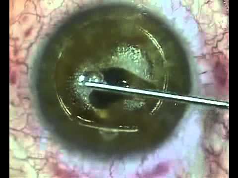FEMTO LASIK - laser miopia, ipermetropia, astigmatismo, presbiopia