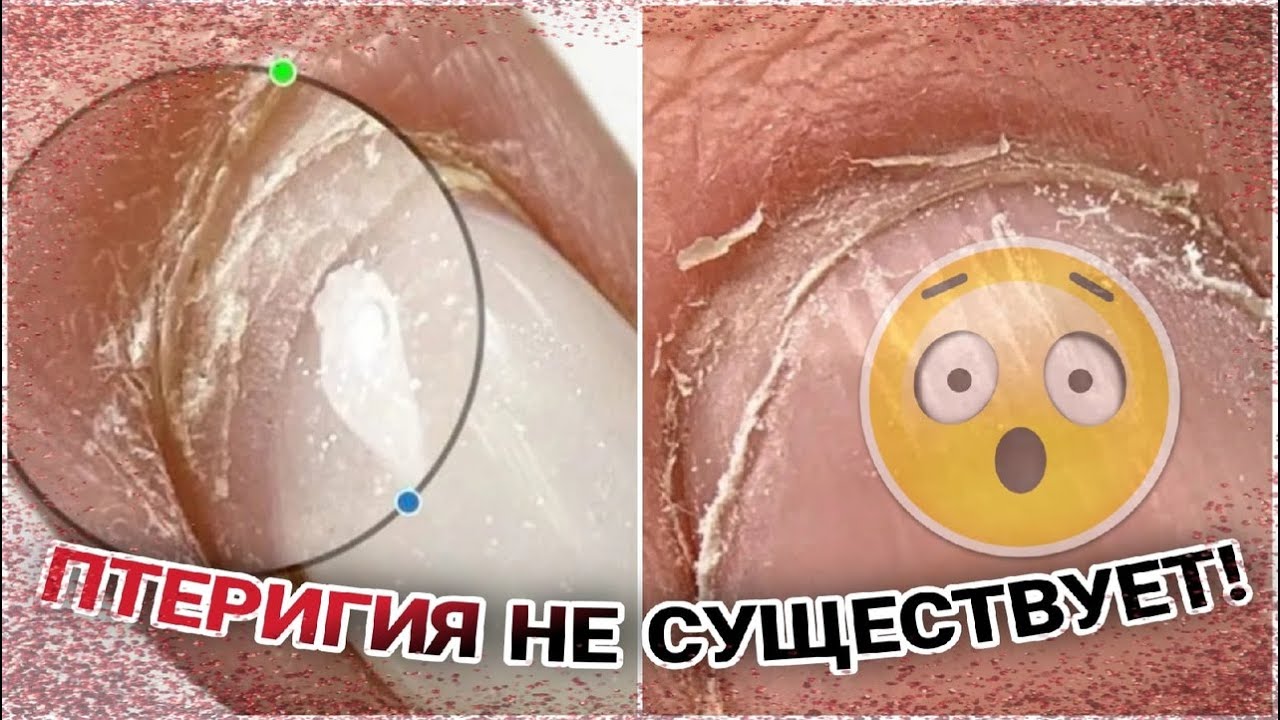 😱Птеригия не существует!😨