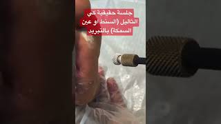 #جلسة #كي#الثالول (#عين السمكة) الفيديو القادم