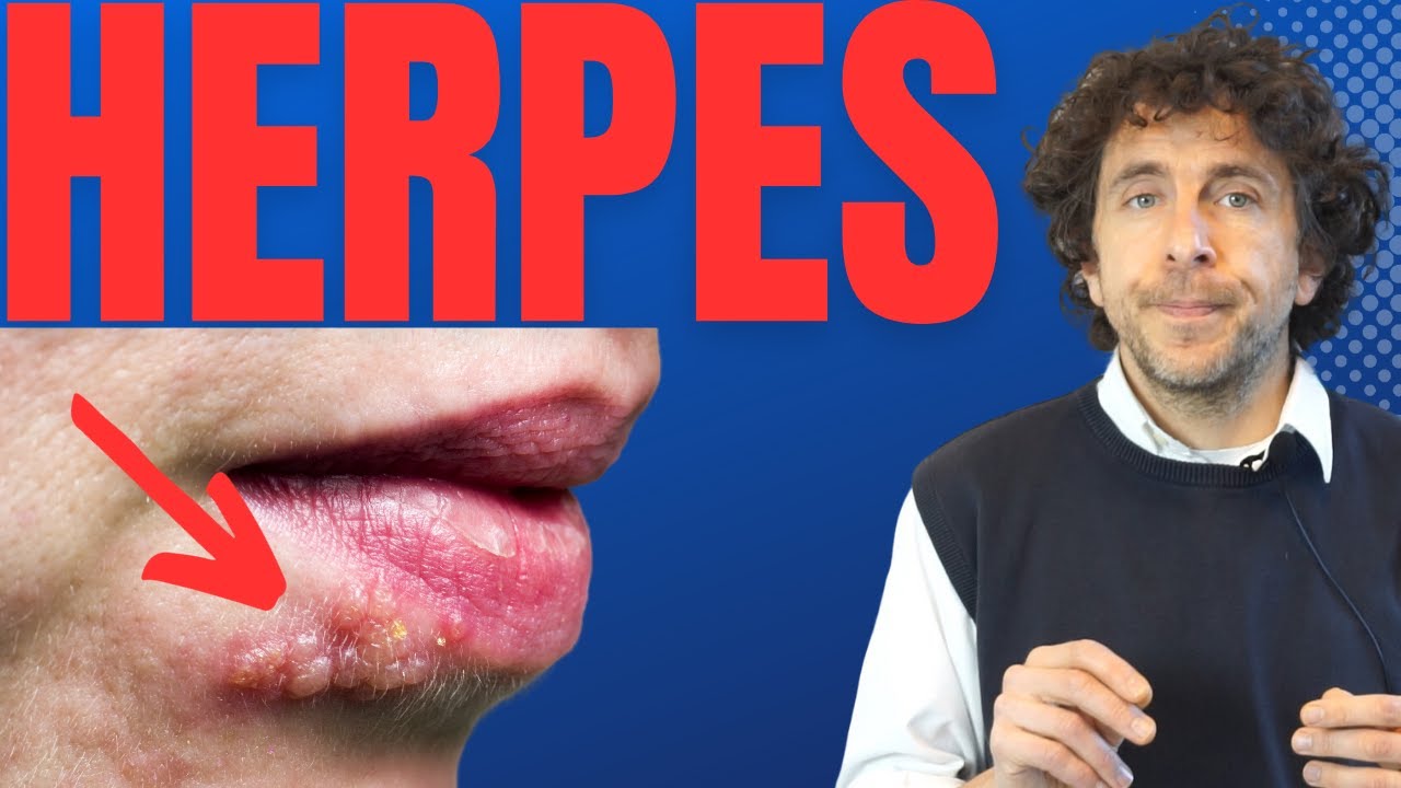 Herpes simplex (sulle labbra): rimedi, cause e contagio - YouTube