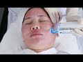 RF microneedling Machine