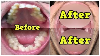 Before & After Braces -Time Lapse - 2 Years & 18 Days - +Mewing