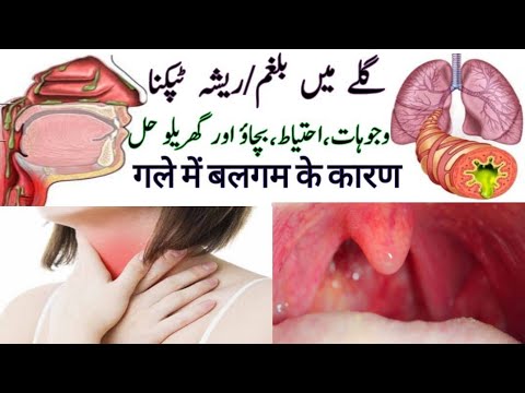 Mucus/Phlegm/Raisha In Throat | Post Nasal Dripping | Causes, Prevention,Home Remedies In Urdu/Hindi