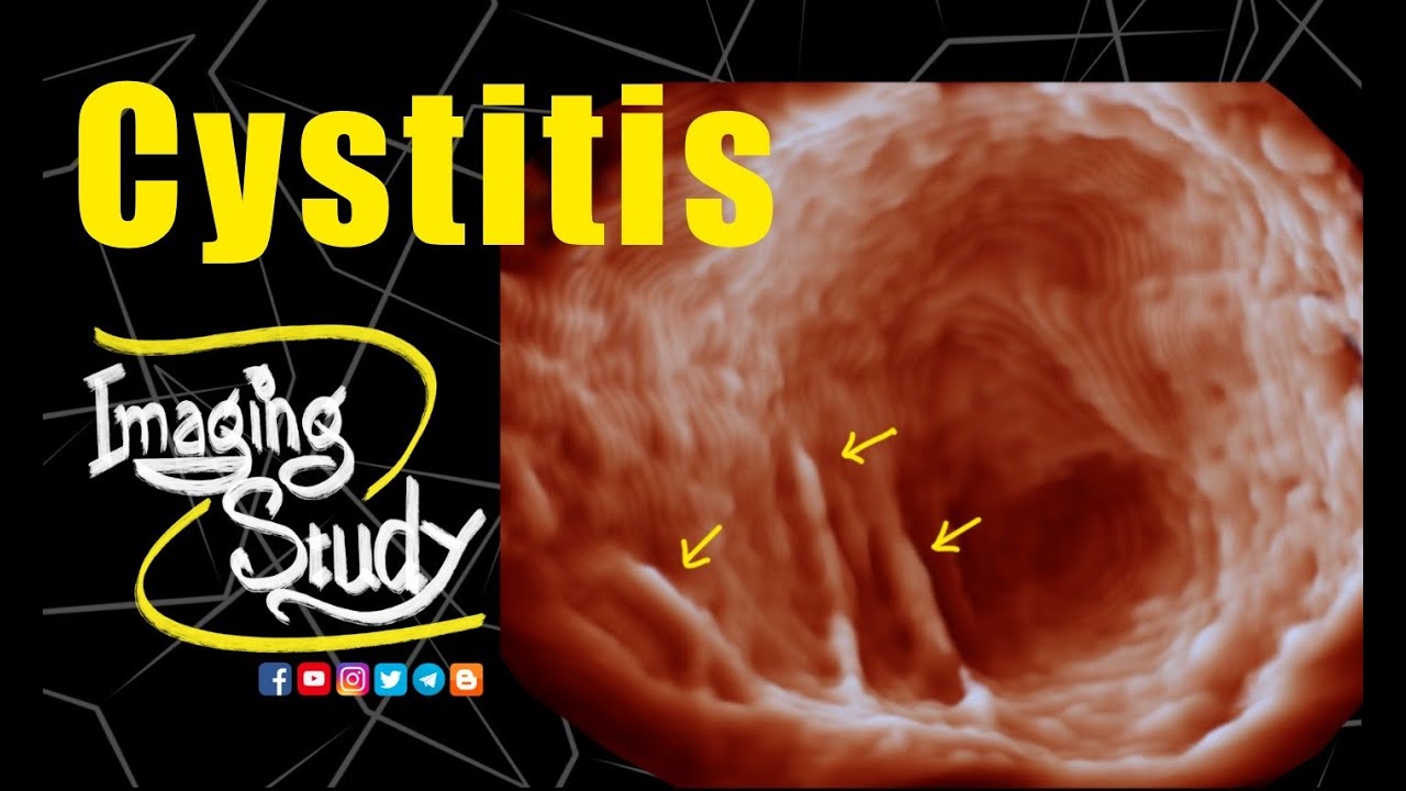 Цистит || УЗИ || 3D || Случай 228