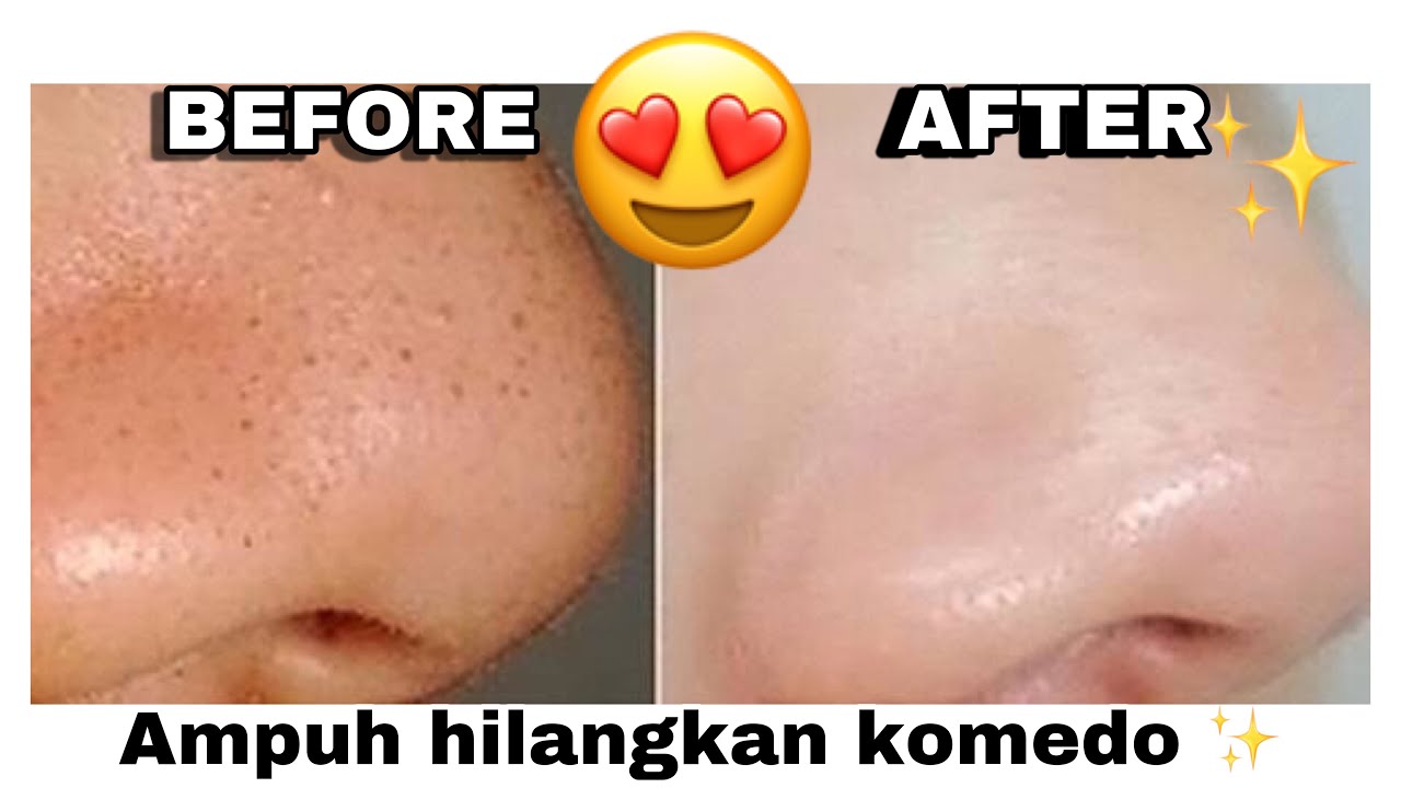 CARA MENGHILANGKAN KOMEDO DENGAN CEPAT HANYA DENGAN 2 BAHAN | TIPS