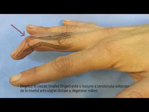 Deget în ciocan | Mallet finger