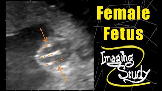 Female Fetus - Its a Girl || Ultrasound || Case 112
