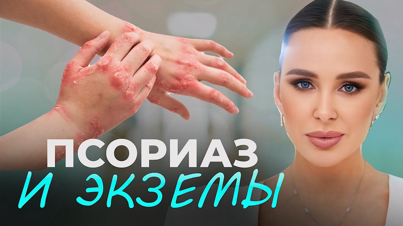НИКАКОЙ КРЕМ НЕ ПОМОЖЕТ | Главная причина псориаза, акне и экзем